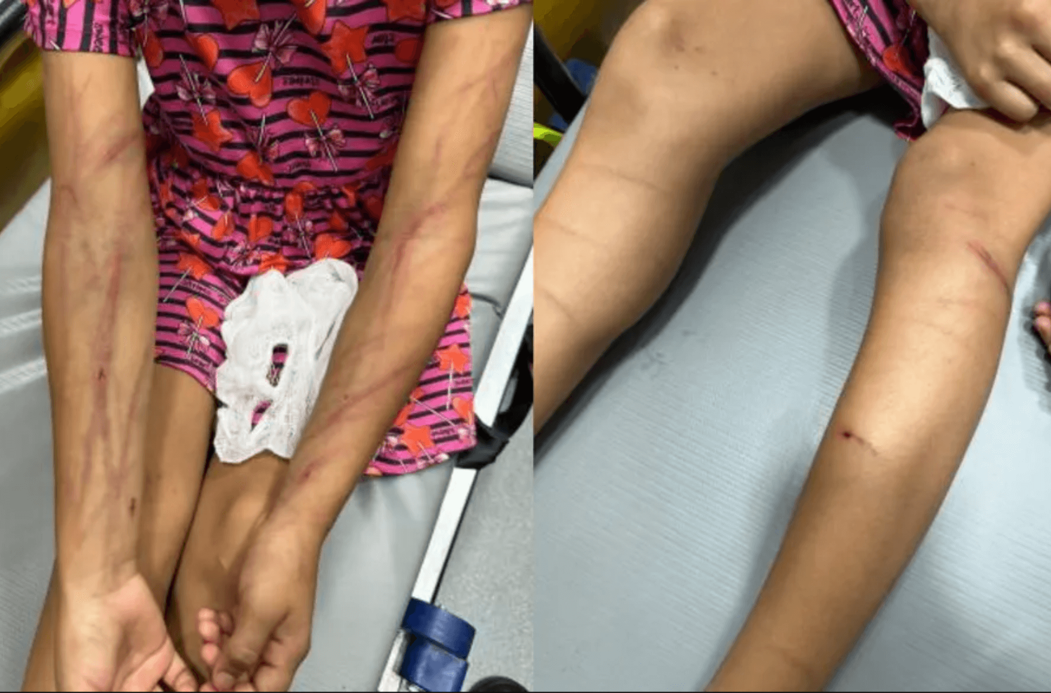 Imagem ilustra os ferimentos da menina.