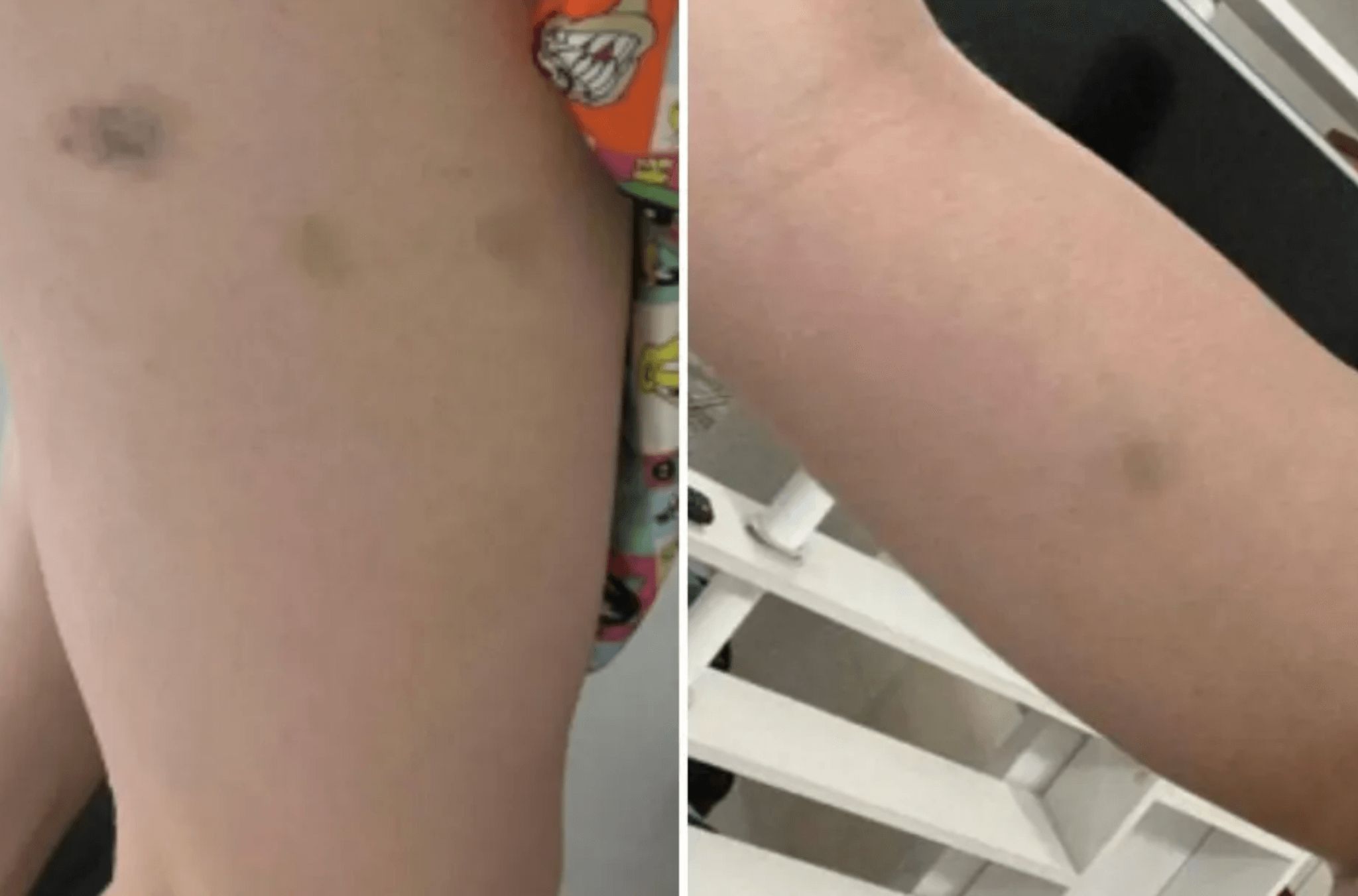 Imagem ilustra os hematomas da cantora.