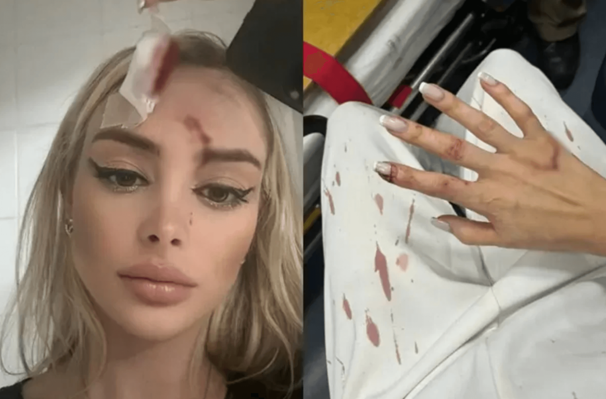 Modelo é ferida por garrafada após ser assediada pelo agressor 