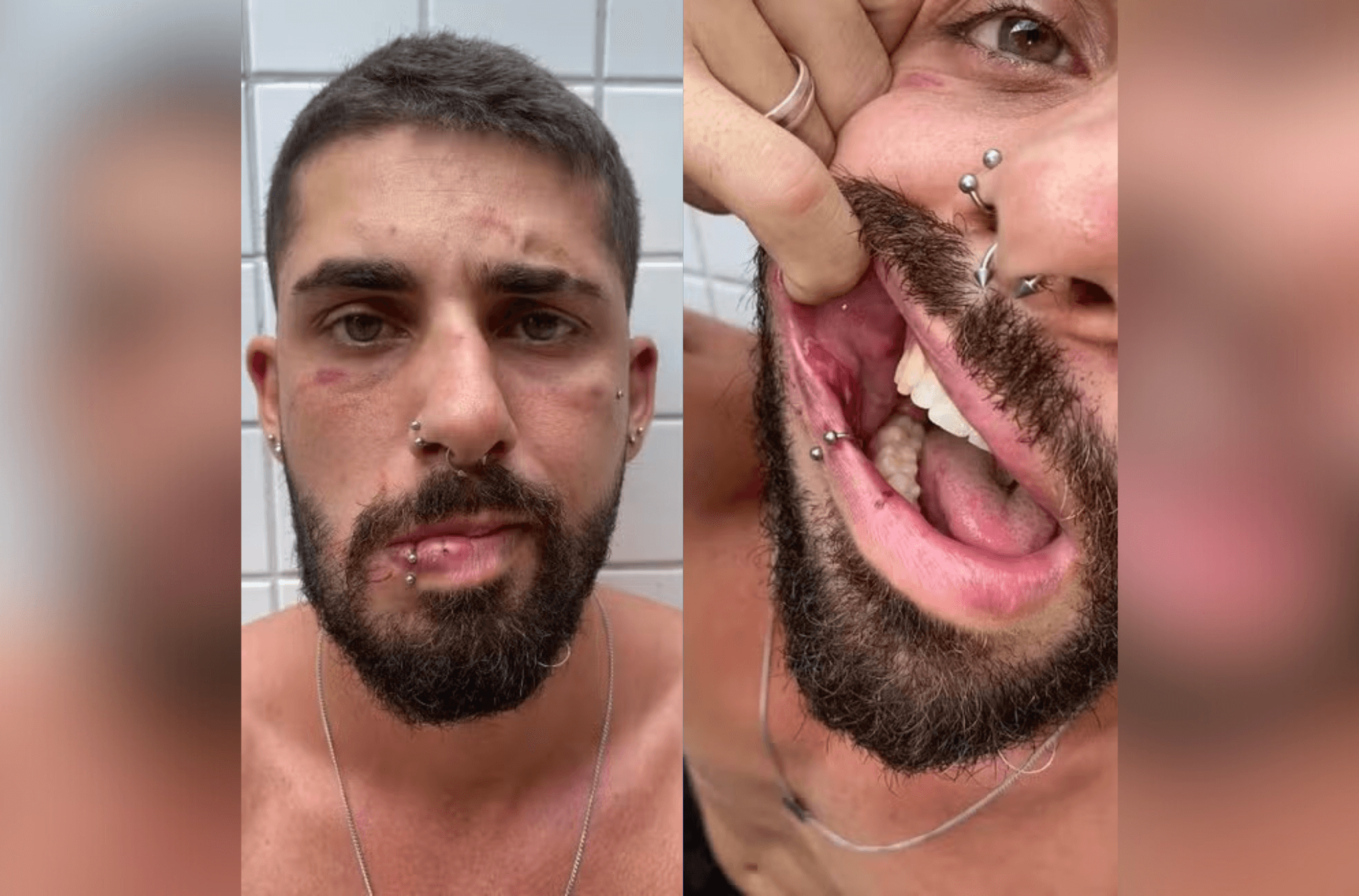 Professor de dança é agredido em bar por grupo de homens 