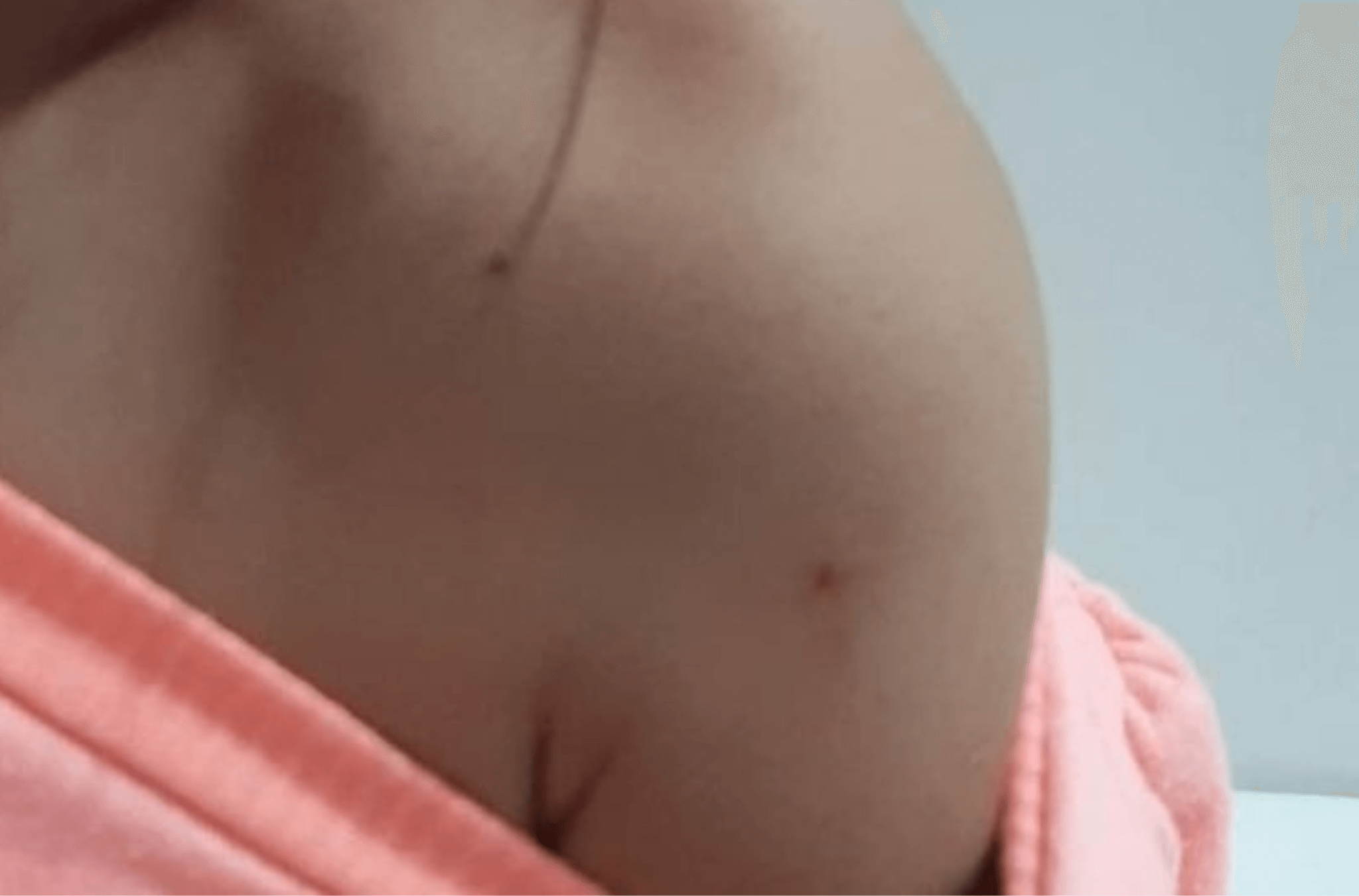 Imagem mostra furo em criança